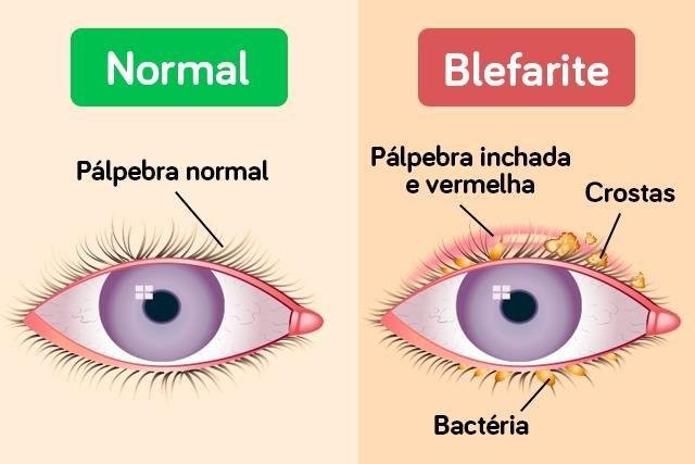 Blefarite, hordéolo e calázio. São a mesma coisa?